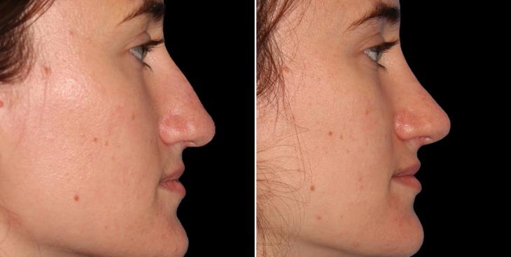 Scarless Nose Surgery Results In Atlanta GA ¾ Right View